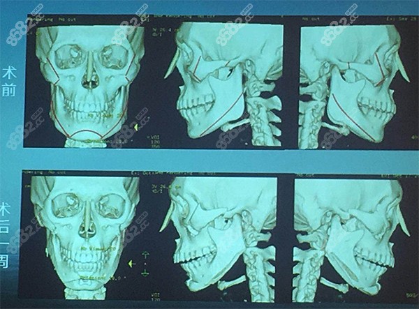 3D人工骨定制修复、复原轮廓