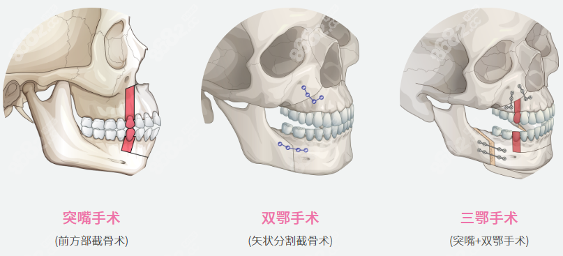 三鄂手术过程图解8682.cc