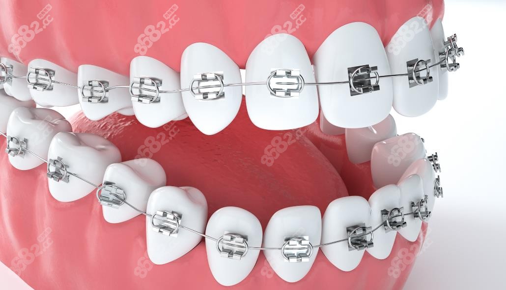 金属矫正示意图