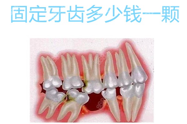 固定义齿多少钱一颗