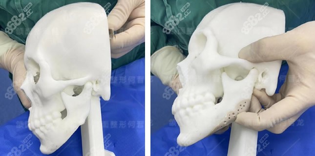 3d打印人工骨修复下颌角图片