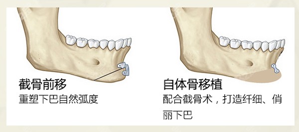 成都友谊医院自体骨移植下巴截骨前移术