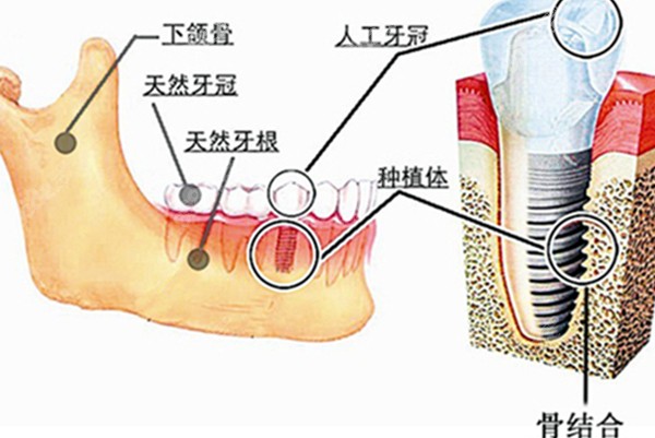 种植牙的结构图