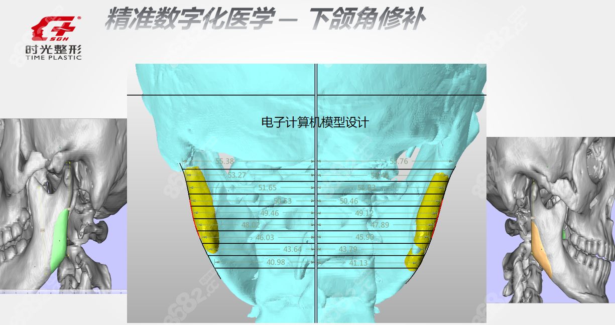 3d打印人工骨修复下颌角怎么样