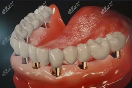 半口种植牙示意图