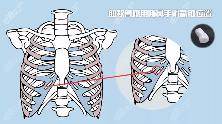 隆鼻中取肋软骨的部位