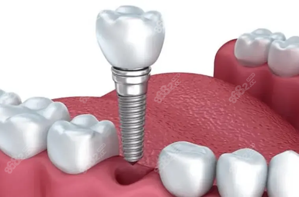 种植牙2千元一颗质量好吗