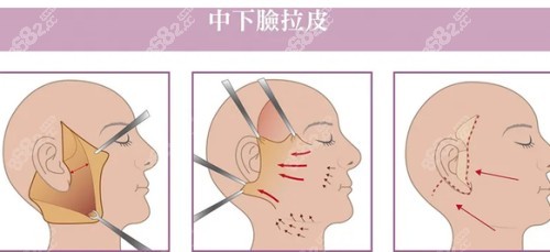 沈阳杏林整形拉皮技术