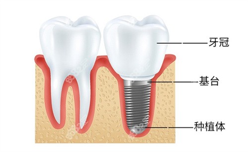 5万/10万全口种植牙有什么区别？
