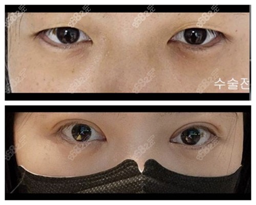韩国珠儿丽整形外科眼底脂肪重排实例