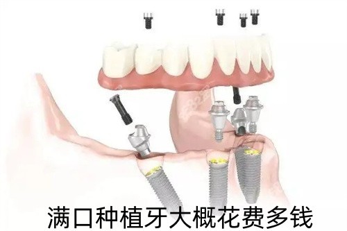 满口种植牙大概花费多钱