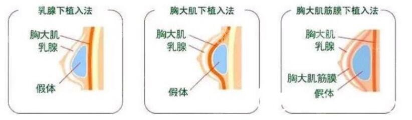 隆胸假体的植入方式分类