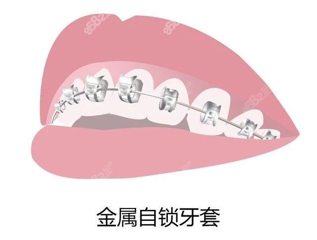 上海闵行区牙齿矫正价格表