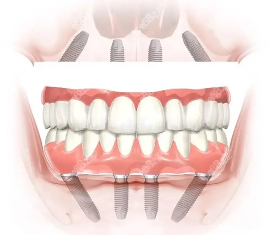 南通满口种植牙医院哪家好？www.8682.cc