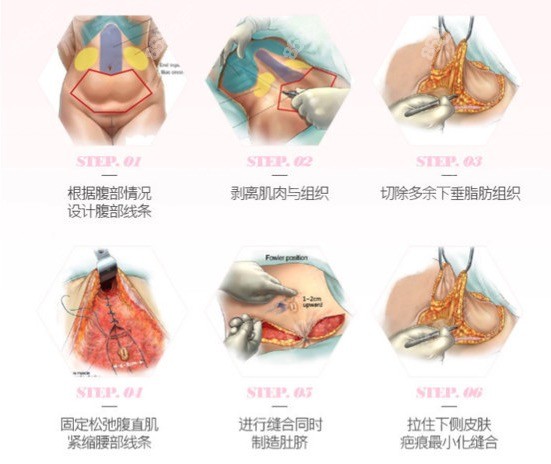 腹壁成形手术过程