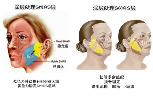 中国面部提升好的医生拉皮手术价格是多少