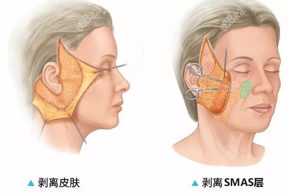 北京加减美面部提升切口位置