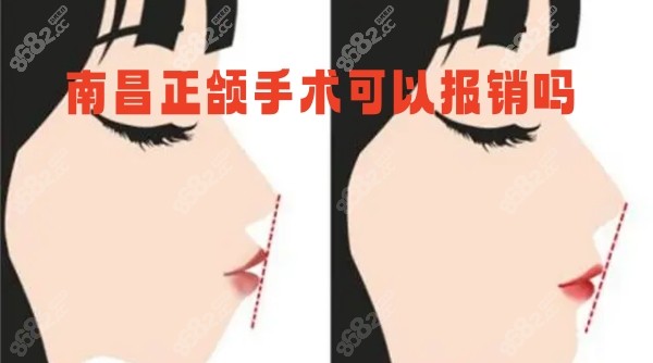 南昌正颌手术可以报销吗