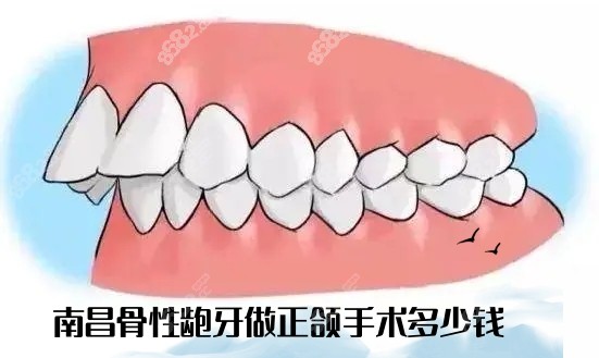 南昌骨性龅牙做正颌手术价格