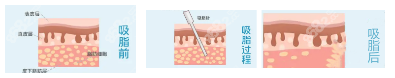 郑州全身抽脂手术