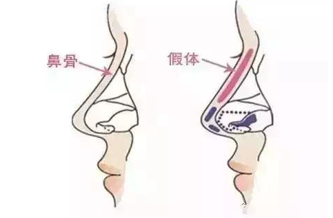 西安高一生隆鼻怎么样