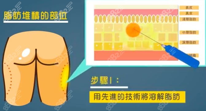 郑州大腿吸脂手术