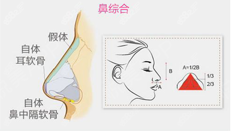 肋骨隆鼻时采用减张处理