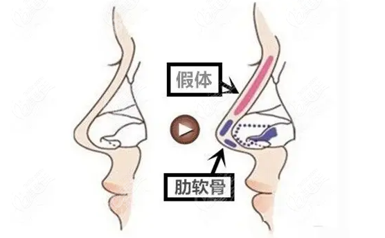 上海华美李健做鼻综合怎么样8682.cc