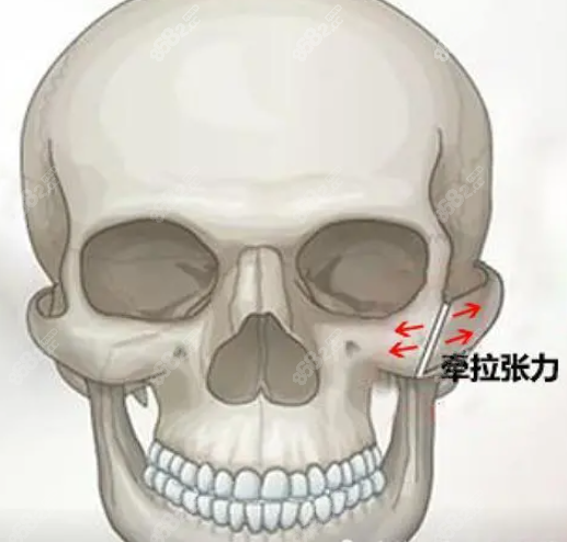 颧骨手术图示
