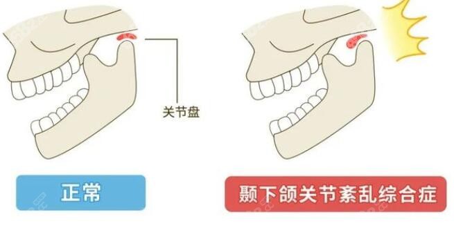 正常的关节和颞下颌关节紊乱导致