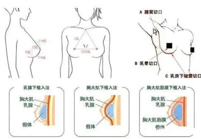 米兰柏羽魏家宾隆胸口碑怎么样？