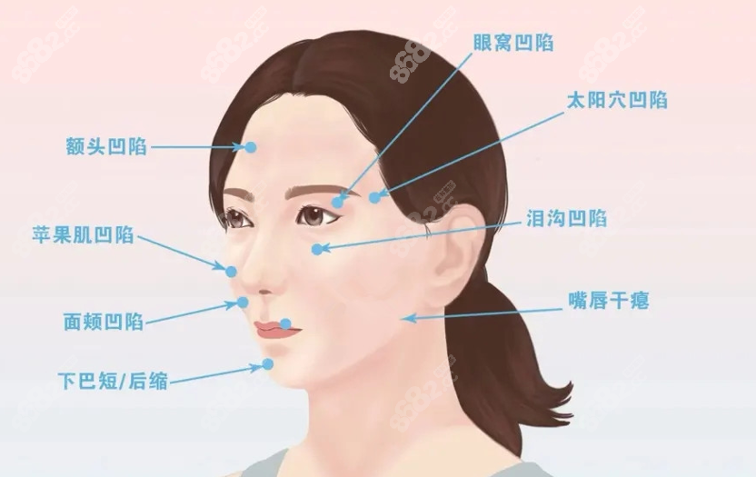 国内脂肪填充出名的医生可以改善面部