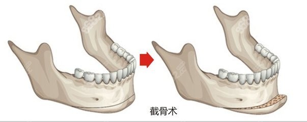 韩国郑志雄磨骨怎么样