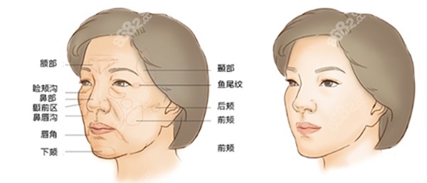 重庆华美医院陈凯医生做脂肪填充面部