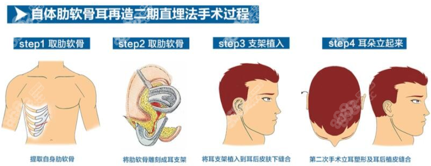 自体肋软骨耳再造手术过程图