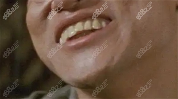 龅牙可以拔掉重新种植吗？