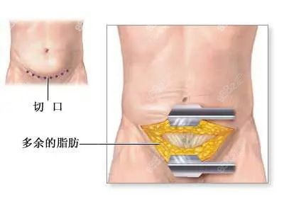 腹壁成型手术价目表分享m.8682.cc.jpg