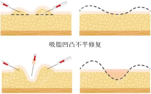 国内吸脂失败修复医生有哪些m.8682.cc