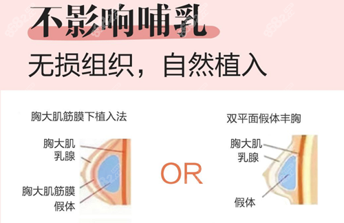 双平面隆胸