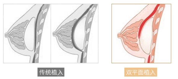 广州黄广香假体隆胸技术优势