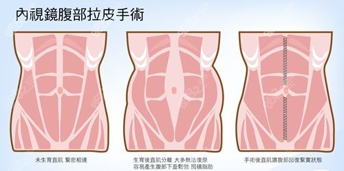 腹壁成型手术价格表分享www.8682.cc.jpg