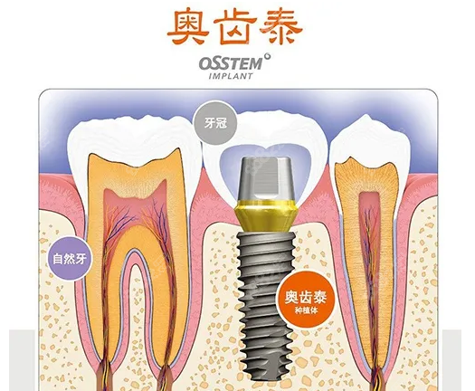 <!--<i data=20240705-sp></i>-->种植牙使用的奥齿泰种植体www.8682.cc