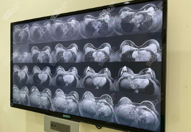 奥美定隆胸钙化做核磁能检查出来