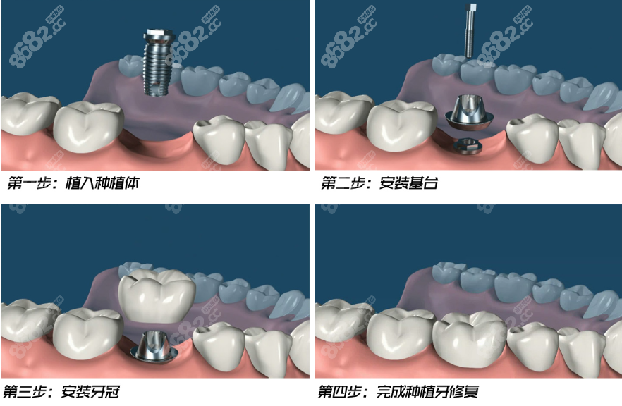 蚌埠口腔医院种植牙价格