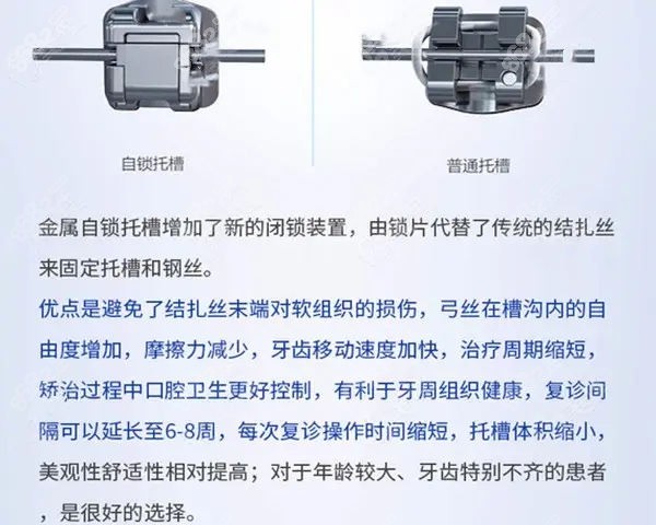 传统托槽和自锁托槽