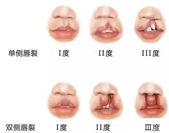 唇裂修复的类型不同