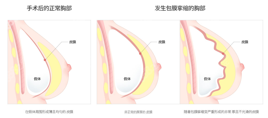 包膜挛缩前后对比