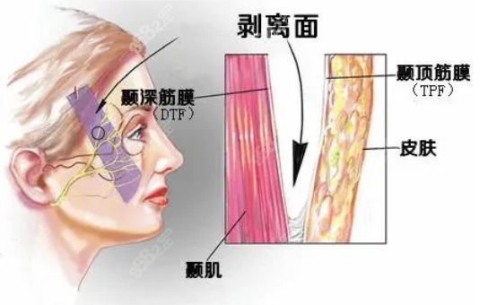 田永成TBM面部提升怎么样