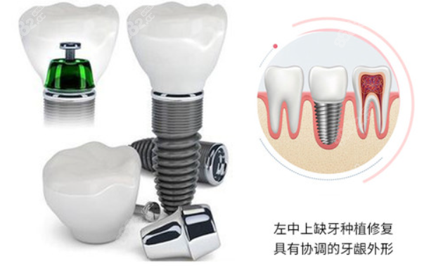 附近1000元的种植牙靠谱吗