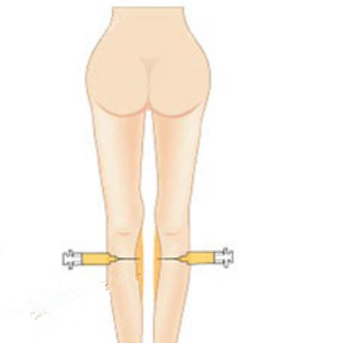 做脂肪加减法直腿术有什么后遗症